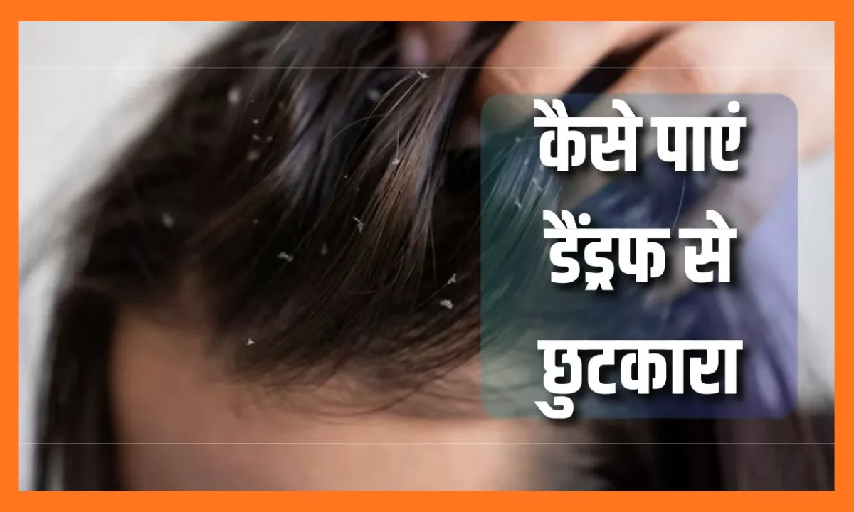 Winter Dandruff Remedies: सर्दियों में डैंड्रफ को अलविदा कहें: 4 प्रभावी घरेलू हेयर मास्क जो जड़ से समस्या हल करेंगे